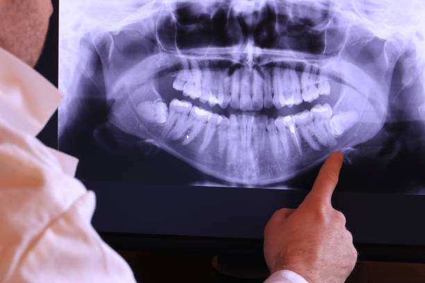 Best Emergency Dentist for Lost Fillings or Crowns in Island Heights, NJ